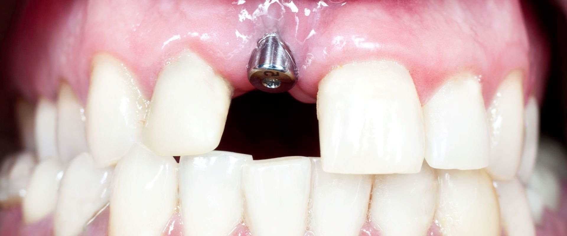 In which bone does the highest rate of implant failure occur?