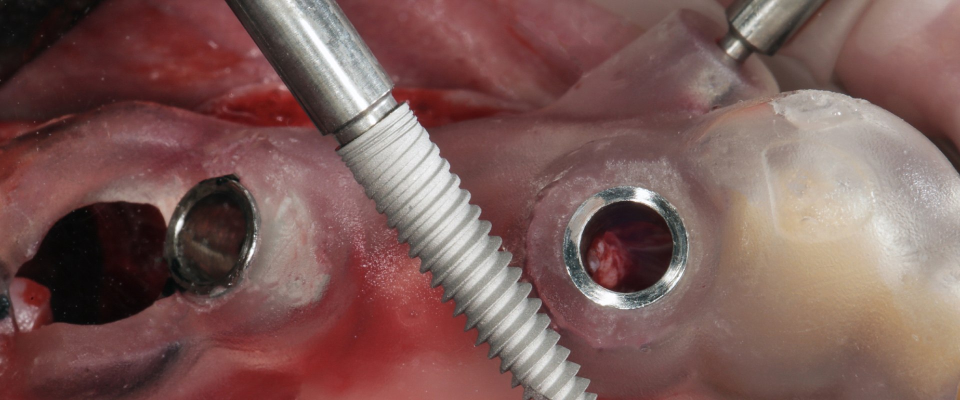 Which of the following is the most common complication from implant surgery?