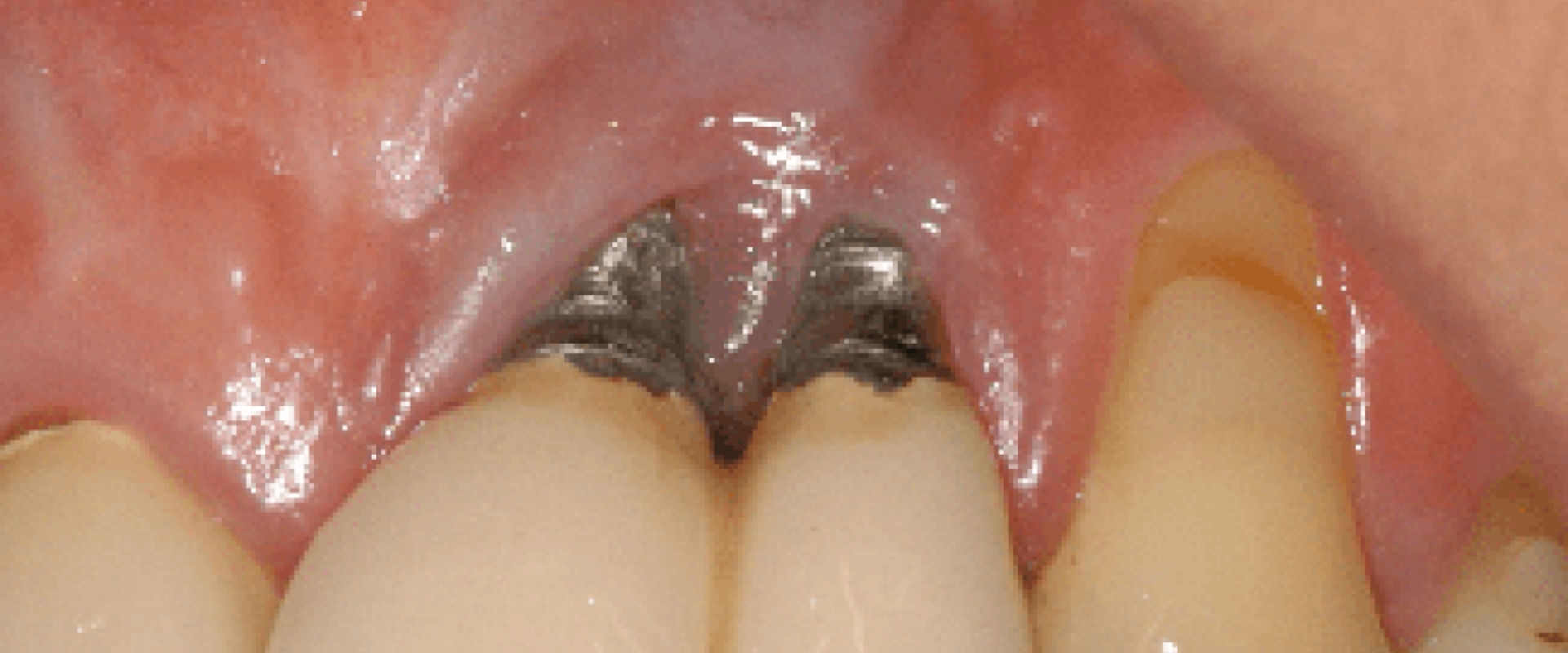 When do dental implants go wrong?