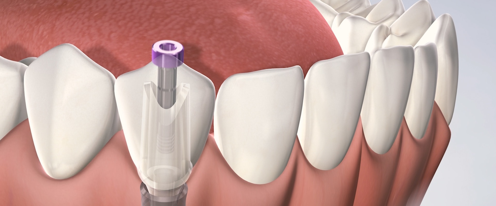 How long does implant insertion pain last?