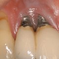 What is the major problem in dental implants?
