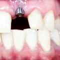 In which bone does the highest rate of implant failure occur?