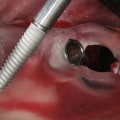 Which of the following is the most common complication from implant surgery?
