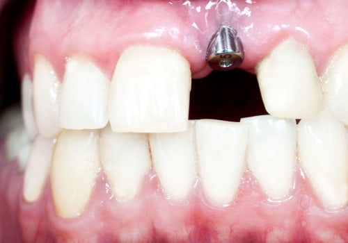 In which bone does the highest rate of implant failure occur?
