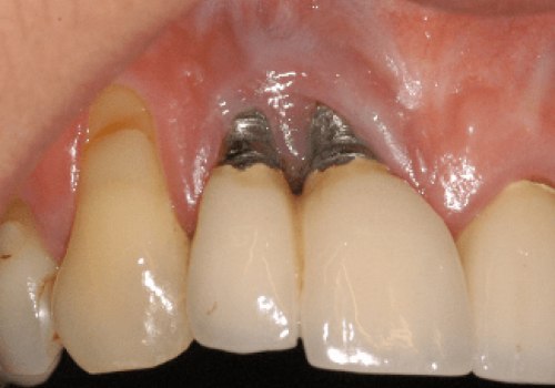 When do dental implants go wrong?