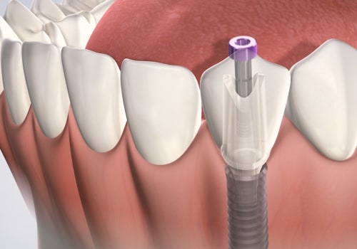 How long does implant insertion pain last?